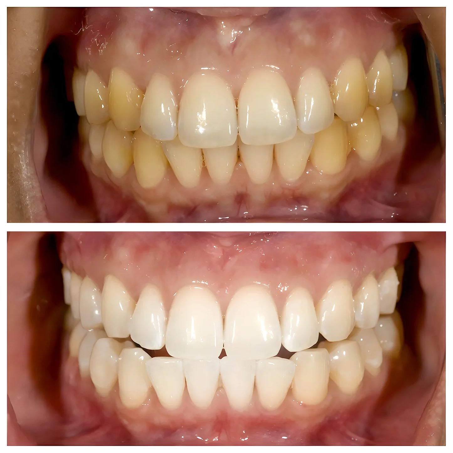 💖Niacinamide toothpaste for dazzling white teeth🦷Pearly white teeth🦷The new secret weapon for your smile!