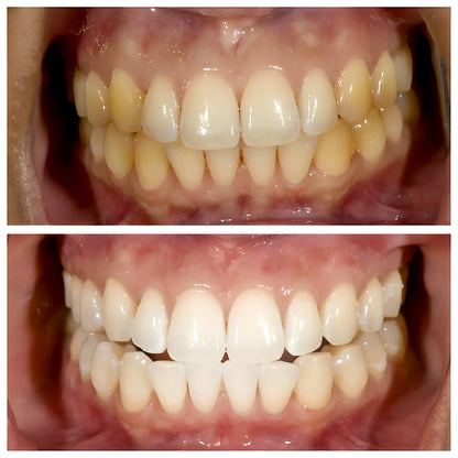 💖Niacinamide toothpaste for dazzling white teeth🦷Pearly white teeth🦷The new secret weapon for your smile!